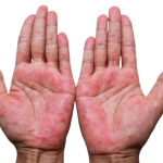 how-do-i-know-if-i-have-eczema-atopic-dermatitis-header-img-removebg-preview