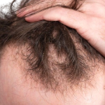 signs-of-balding-removebg-preview